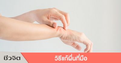 ผื่นผิวหนังและห้าสาเหตุที่พบบ่อยที่สุด อน    
                                                                                    การต