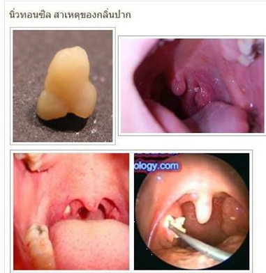 สาเหตุของนิ่วในไตคืออะไร? 